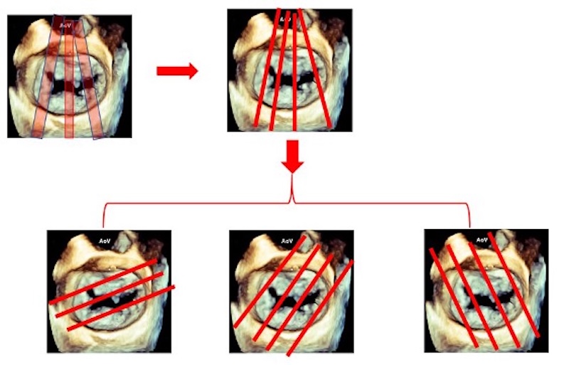 Figura 2. Técnica multiplanar de reformateo de datos volumétricos. Los datos volumétricos adquiridos de la válvula mitral pueden ser cortados virtualmente n múltiples planos ortogonales oblicuos, verticales y horizontales. 
