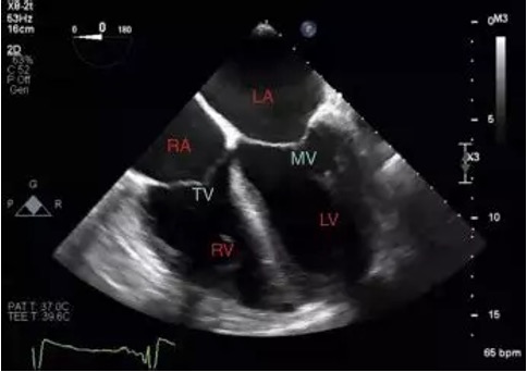 Figura 1: Podemos ver un plano 4 cámaras realizado con ecocardiografía transesofágica. En el podemos observar que la alineación de la pared libre en este plano no es óptima.