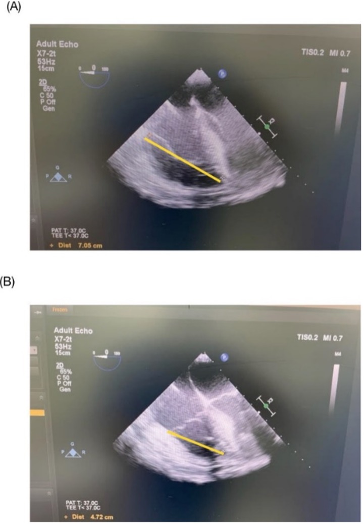 Figura 2: Podemos ver cómo se ha realizado la medición del TAPSE o TAPSE modificado. La foto A) corresponde a final de la diástole. Podemos ver una línea amarilla que mide la distancia entre base del anillo tricúspideo al ápex. La foto B) corresponde con final de la sístole. La línea amarilla utiliza las mismas referencias que antes. Mediante la diferencia podemos ver cuanta contracción longitudinal se ha realizado. 