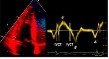 Análisis de la onda S en Doppler tisular