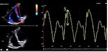 Análisis de la onda S en Doppler color