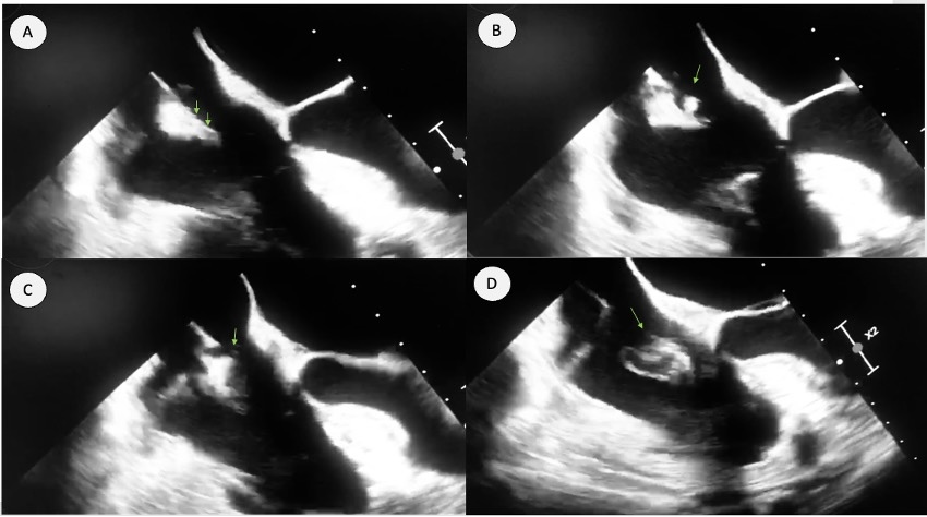 Figura 4. ETE 2D. Trombo no diagnosticado preoperatoriamente objetivado en electrodo auricular de marcapasos durante monitorización con ETE intraoperatorio de procedimiento de EET. Se muestra el trombo como un elemento móvil, hiperecogénico, de bordes bien delimitados inicialmente adherido al borde libre del electrodo auricular (A y B, flechas verdes). Se objetiva cómo durante el procedimiento de EET se produce separación del trombo del electrodo y suelta a la circulación pulmonar (C y D). Posteriormente se diagnosticó un TEP agudo. 