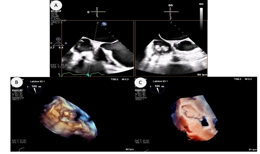 Figura 5. A (ETE 2D): Imagen móvil de gran tamaño (27 x 13 mm), multilobulada, de movimiento anárquico, anclada en pared posterolateral de la aurícula derecha, con base ancha de implantación justo por encima de la inserción del velo tricúspide (comisura antero-posterior) y en íntimo contacto con los electrodos ventriculares de marcapasos. La imagen B muestra una reconstrucción 3D y la imagen C una reconstrucción 3D con transiluminación para visualizar mejor la estructura. En el contexto clínico con una situación de shock séptico y bacteriemia la sospecha clínica fue endocarditis infecciosa. 