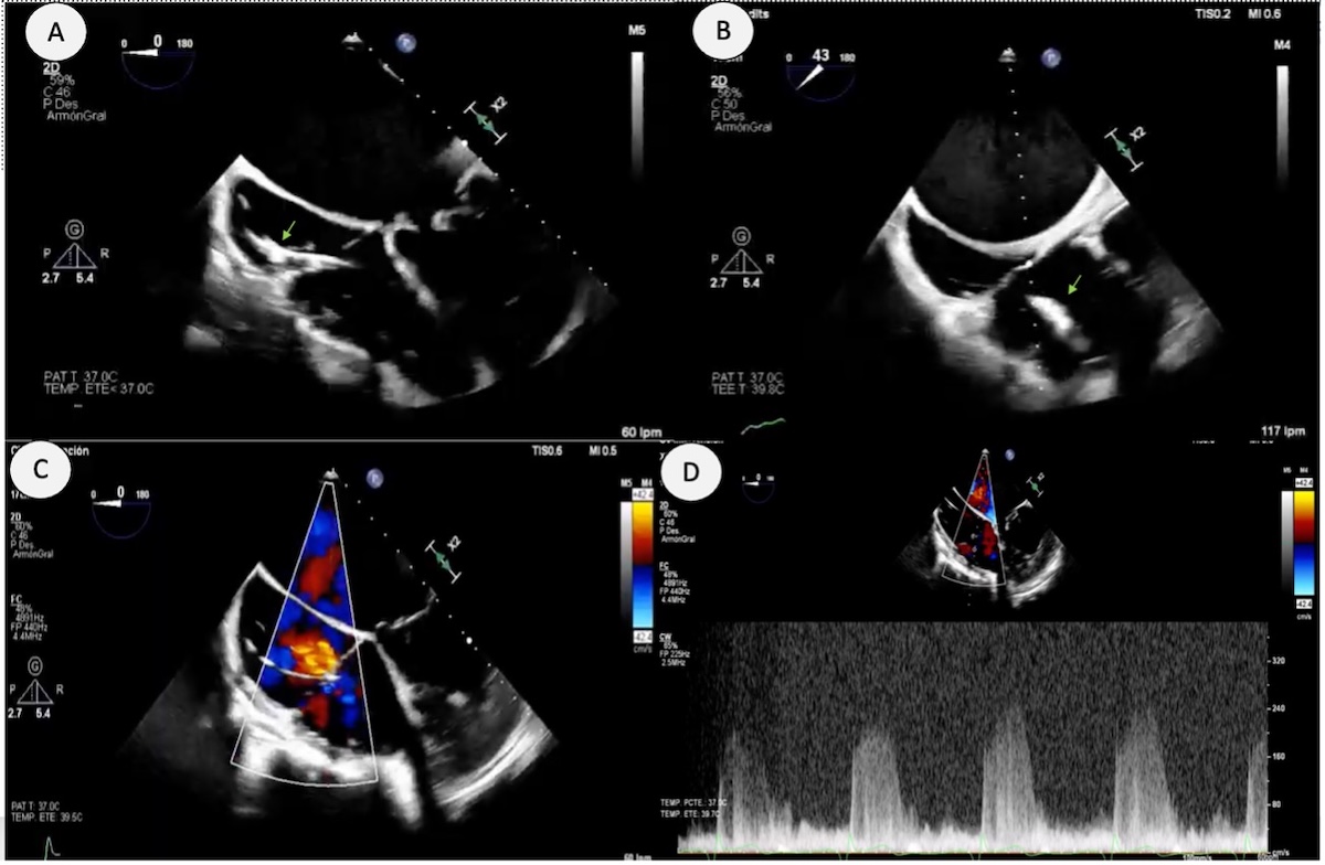 Figura 7. Paciente con cardiopatía congénita (levo-transposición de grandes arterias congénitamente corregida) con marcapasos de larga data. Se observa engrosamiento del electrodo tanto en su porción auricular (A) como ventricular (B) sugestivo de fibrosis o calcificación. Además, el electrodo condiciona una IT leve-moderada de origen central de la válvula en posición subpulmonar (C) que permite estimar un gradiente AD-VI subpulmonar de 40 mmHg (D). 