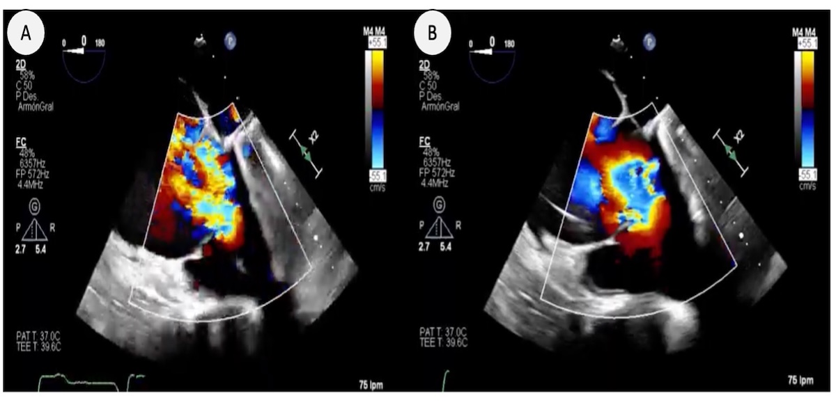 Figura 9. Insuficiencia tricúspide masiva secundaria a electrodo de marcapasos con mecanismo secundario a imposibilidad de cierre de la valva anterior ocasionando un flujo Doppler con morfología ventricularizada siendo la PSAP no valorable (Vena contracta IT: 1.40cm) 