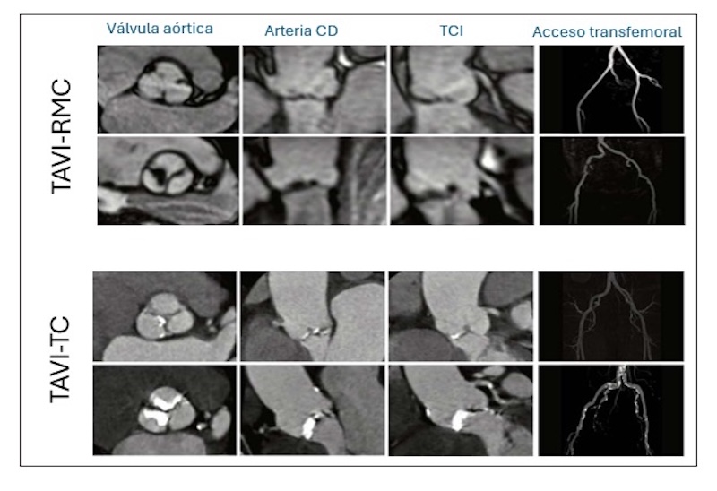 Figura 3: Ejemplos de pacientes sometidos a TAVI-RMC y TAVI-TC. CD: arteria coronaria derecha. TCI: tronco coronario izquierdo.