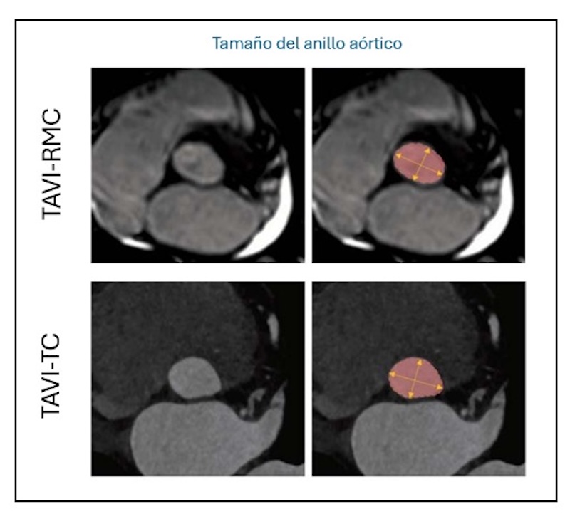 Figura 4: Tamaño del anillo aórtico medido por el protocolo TAVI-RMC y TAVI-TC Figura 4: Tamaño del anillo aórtico medido por el protocolo TAVI-RMC y TAVI-TC