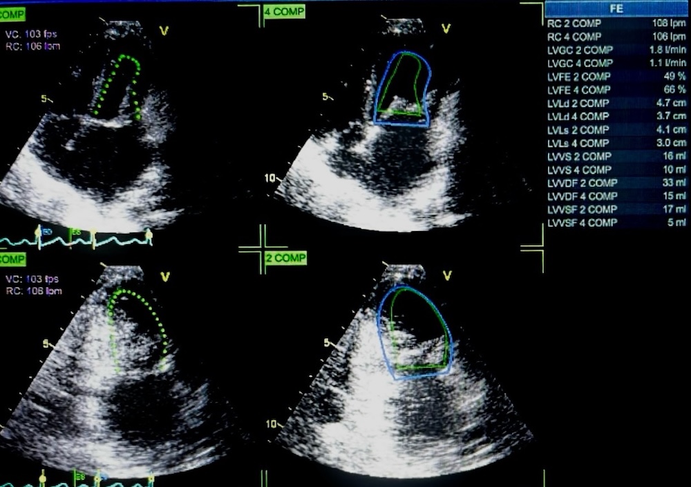 Figura 4. LVEF por metodo biplanar (Simpson). Dr. Johann David A. Morales Ojeda. Imágenes propias.