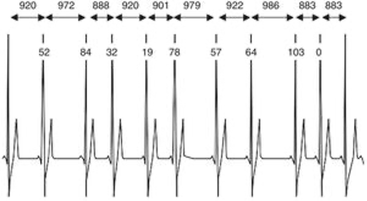 Figura 1. Ejemplo de un trazado de ECG con más de once complejos QRS. Se muestran los tiempos de intervalo R-R y la diferencia entre los intervalos R-R adyacentes. Figura 1. Ejemplo de un trazado de ECG con más de once complejos QRS. Se muestran los tiempos de intervalo R-R y la diferencia entre los intervalos R-R adyacentes.
