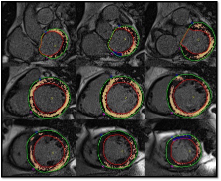 Figura 2 – Cuantificación de la fibrosis. Se delinearon de forma semiautomática los contornos epicárdico y endocárdico (verde y rojo, respectivamente) y luego se cuantificó la fibrosis utilizando umbrales de >2DS color rosa (FZG) y >5DS color amarillo (FT) lo que permite visualizar la diferencia entre ambas zonas.