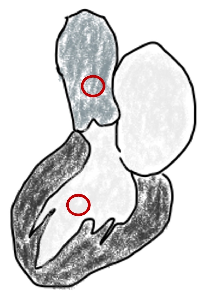 Figura 1: Representación de un corte de 3 cámaras bSSFP, con ROI en aorta ascendente y VI, necesarios para calcular la ratio Ao:VI.