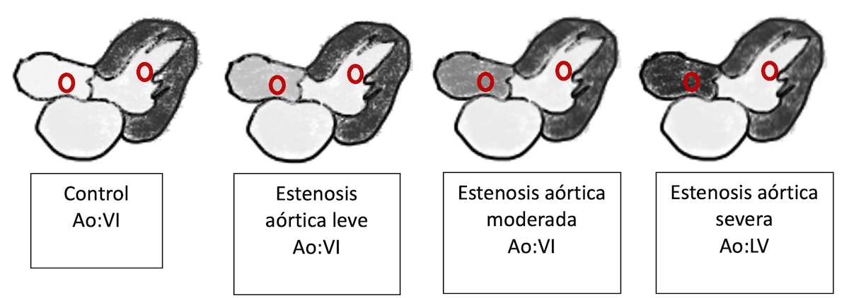 Figura 2: Representación de un corte de 3 cámaras bSSFP en cada uno de los 4 grupos (control, estenosis aórtica leve, moderada y severa), con la relación Ao:VI correspondiente a cada grupo. Nótese que la diferencia entre todos los grupos es estadísticamente significativa (p<0,001).