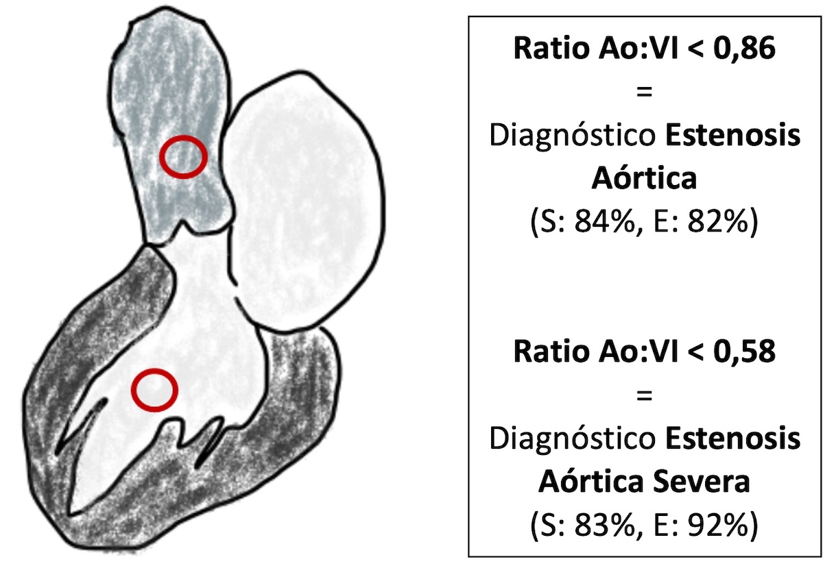 Figura 3: Valores o puntos de corte para el diagnóstico de estenosis aórtica (de cualquier grado de gravedad) y de estenosis aórtica severa, con sus respectivos niveles de sensibilidad (S) y especificidad (E).