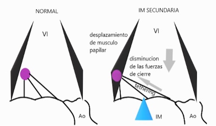 Figura 3: Mecanismos de insuficiencia mitral secundaria. A la izquierda, las fuerzas normales que permiten una coaptación valvular normal. A la derecha, los cambios que se producen en la insuficiencia mitral secundaria. El ángulo normal entre los músculos papilares y el plano del anillo determina el efecto de tethering de las cuerdas tendinosas. Las enfermedades que desplazan el musculo papilar o distorsionan la geometría ventricular (como la patología isquémica) afecta el mecanismo de tethering normal, disminuyendo las fuerzas de cierre y provocando una coaptación inadecuada. Fuente: Otto CM. The practice of clinical echocardiography.15° Ed.Philadelphia:El servier, 2017 Figura 3: Mecanismos de insuficiencia mitral secundaria. A la izquierda, las fuerzas normales que permiten una coaptación valvular normal. A la derecha, los cambios que se producen en la insuficiencia mitral secundaria. El ángulo normal entre los músculos papilares y el plano del anillo determina el efecto de tethering de las cuerdas tendinosas. Las enfermedades que desplazan el musculo papilar o distorsionan la geometría ventricular (como la patología isquémica) afecta el mecanismo de tethering normal, disminuyendo las fuerzas de cierre y provocando una coaptación inadecuada. Fuente: Otto CM. The practice of clinical echocardiography.15° Ed.Philadelphia:El servier, 2017