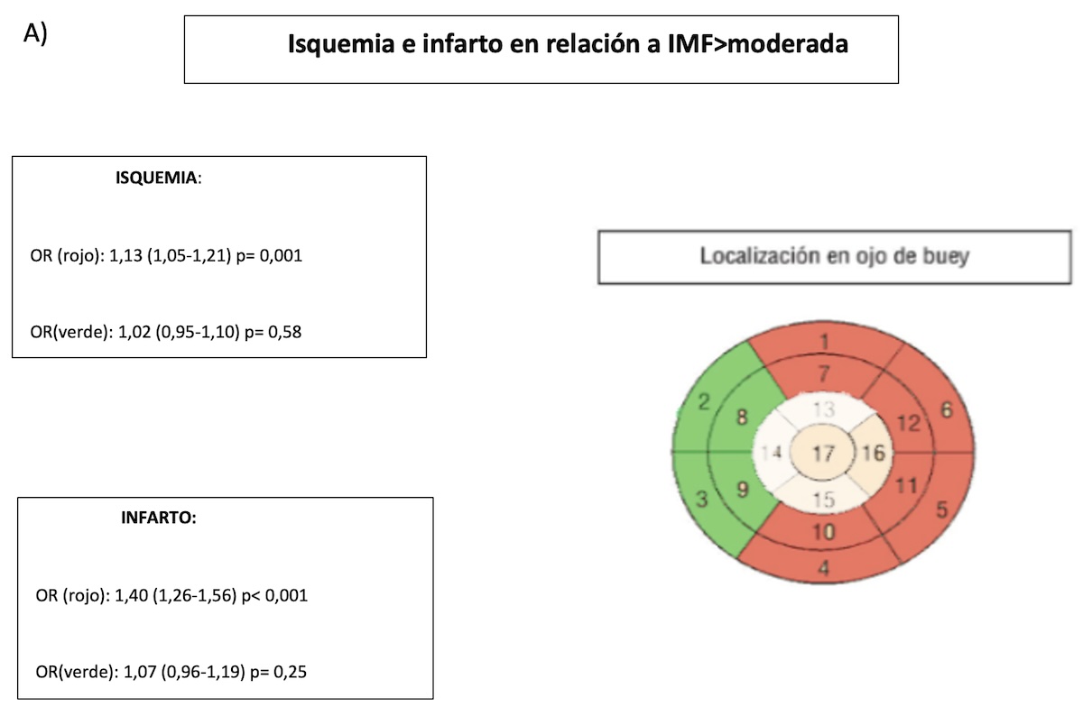 Figura 4: A) Ojo de Buey de 17 segmentos ilustrando el miocardio ventricular izquierdo concordante con el aparato valvular mitral y los segmentos adyacentes a los músculos antero lateral y postero medial. ROJO: segmentos subpapilares (anterior basal y medio, anterolateral basal y medio, inferior basal y medio e inferolateral basal y medio). VERDE: segmentos de miocardio remoto. Se evidencia que la isquemia de los segmentos subpapilares se asociaron a IMF mayor/igual a moderada (P = 0,001) comparado con segmentos remotos (P NS). Lo mismo sucede con el infarto en segmentos subpapilares (P < 0,001) comparado con segmentos remotos (P NS). Figura 4: A) Ojo de Buey de 17 segmentos ilustrando el miocardio ventricular izquierdo concordante con el aparato valvular mitral y los segmentos adyacentes a los músculos antero lateral y postero medial. ROJO: segmentos subpapilares (anterior basal y medio, anterolateral basal y medio, inferior basal y medio e inferolateral basal y medio). VERDE: segmentos de miocardio remoto. Se evidencia que la isquemia de los segmentos subpapilares se asociaron a IMF mayor/igual a moderada (P = 0,001) comparado con segmentos remotos (P NS). Lo mismo sucede con el infarto en segmentos subpapilares (P < 0,001) comparado con segmentos remotos (P NS).