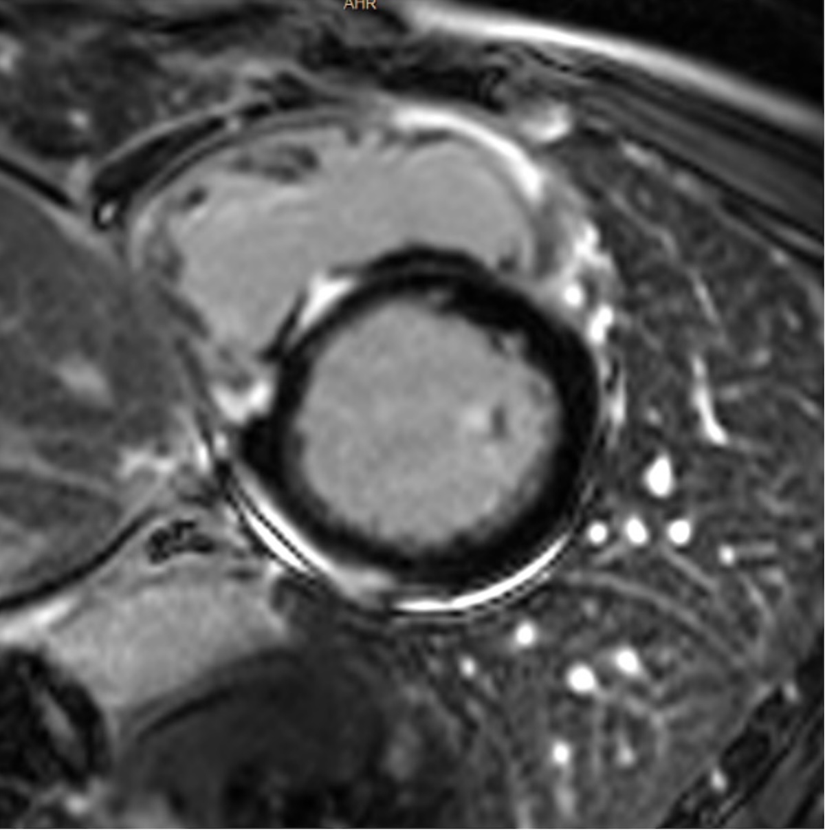 Figura 3. Secuencia de realce tardío de gadolinio, inversión recuperación, potenciada en T1. Eje corto basal. Fibrosis de reemplazo intramiocárdica septal, subepicárdica inferior y en cara anterior de VD en varón de 43 años que debutó con arritmias ventriculares.