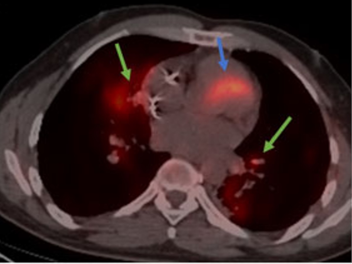 Figura 4. FDG-PET. Captación en septo interventricular (flecha azul), pequeños nódulos peribroncovasculares, hígado y bazo (flechas verdes).