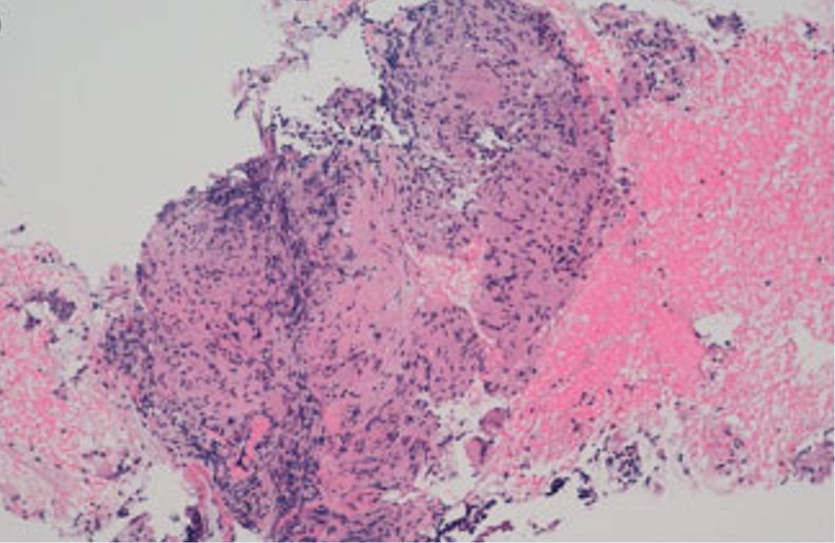 Figura 6. Anatomía patológica. Granulomas no caseosos.
