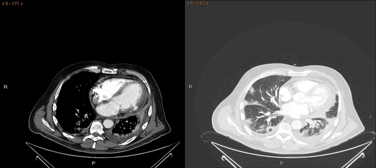 Figura 4. Varón de 72 años que presenta afectación por Covid-19, que presenta IAM revascularizado con ICP de arteria circunfleja. Tras realizar AngioTC para descartar TEP se identifica pseudoaneurisma de pared lateral del VI. En ventana de parénquima se observan infiltrados pulmonares bilaterales de predominio periférico secundarios a afectación por Covid-19. Figura 4. Varón de 72 años que presenta afectación por Covid-19, que presenta IAM revascularizado con ICP de arteria circunfleja. Tras realizar AngioTC para descartar TEP se identifica pseudoaneurisma de pared lateral del VI. En ventana de parénquima se observan infiltrados pulmonares bilaterales de predominio periférico secundarios a afectación por Covid-19.