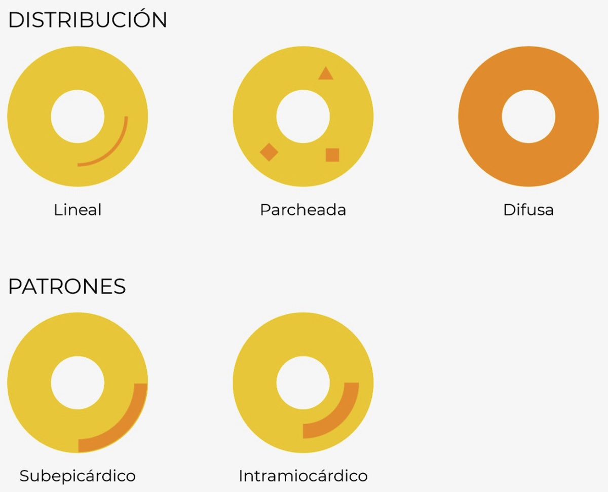 Figura 5. En esta ilustración se representa un circunferencia que representa al ventrículo izquierdo en eje corto y las distintas formas de afectación del RTG. La distribución del RTG puede presentarse de forma lineal, parcheada o difusa y los patrones de afectación encontrados son subepicárdico e intramiocárdico. Figura 5. En esta ilustración se representa un circunferencia que representa al ventrículo izquierdo en eje corto y las distintas formas de afectación del RTG. La distribución del RTG puede presentarse de forma lineal, parcheada o difusa y los patrones de afectación encontrados son subepicárdico e intramiocárdico.