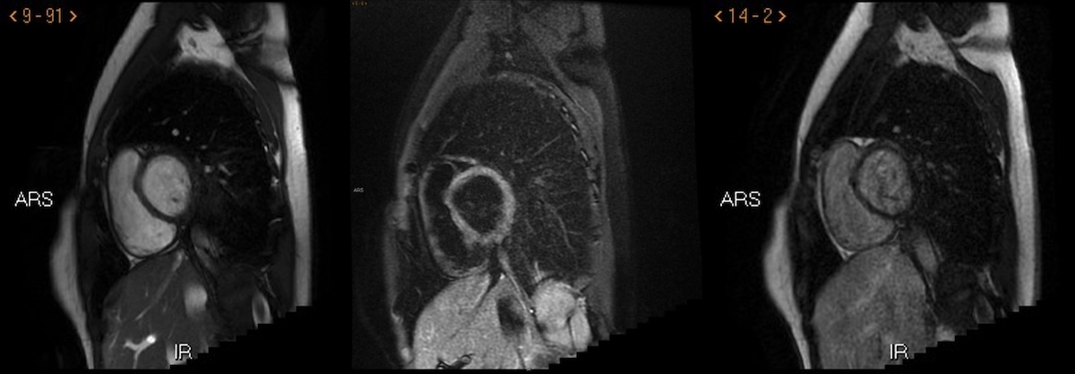Figura 7. Mujer de 36 años que presenta infección por covid-19 en octubre del 2020, sin hospitalización. Posteriormente comienza con cuadro de dolor torácico, disnea y palpitaciones. Se realiza estudio de RMC en diciembre del 2021, donde se identifica RTG a nivel de cara anterolateral del VI, diagnosticándose de Miocarditis tras infección por Covid-19. Las imágenes representadas son ejes cortos en SSFP, STIR y estudio de viabilidad miocárdica. Figura 7. Mujer de 36 años que presenta infección por covid-19 en octubre del 2020, sin hospitalización. Posteriormente comienza con cuadro de dolor torácico, disnea y palpitaciones. Se realiza estudio de RMC en diciembre del 2021, donde se identifica RTG a nivel de cara anterolateral del VI, diagnosticándose de Miocarditis tras infección por Covid-19. Las imágenes representadas son ejes cortos en SSFP, STIR y estudio de viabilidad miocárdica.