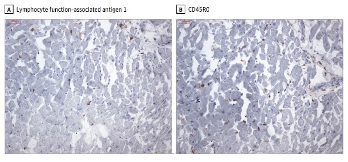 Figura 1. Hallazgos histológicos: presencia de edema intracelular, hipertrofia de miocitos y ausencia de fibrosis por reemplazo en el intersticio. Tinción IHQ para antígeno 1 y antígeno T de linfocitos activos (en color marrón). Muestra obtenida en el día 67 post-COVID de un hombre adulto sin afecciones predisponentes, ni uso de medicación domiciliaria, con presencia de síntomas leves (disminución del olfato y fiebre durante 2 días) y recuperación domiciliaria.042a