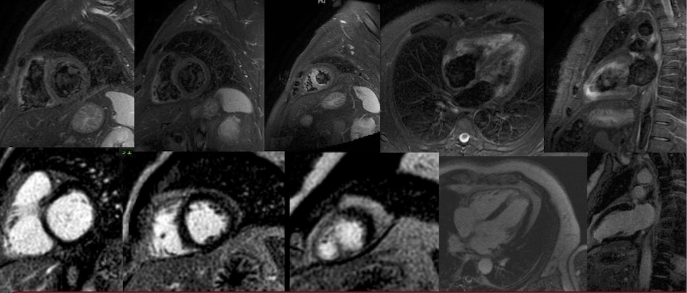 Figura 2. RMC de paciente varón de 54 años, que ingresa por MSCR, con irregularidades no significativas, no identificándose bien la DA distal en coronarografía. STIR - Edema en segmentos septal e inferior apicales. Secuencia de supresión miocárdica - RTG en segmentos septal e inferior apicales compatibles con necrosis. Hallazgos en relación con infarto agudo apical. Figura 2. RMC de paciente varón de 54 años, que ingresa por MSCR, con irregularidades no significativas, no identificándose bien la DA distal en coronarografía. STIR - Edema en segmentos septal e inferior apicales. Secuencia de supresión miocárdica - RTG en segmentos septal e inferior apicales compatibles con necrosis. Hallazgos en relación con infarto agudo apical.