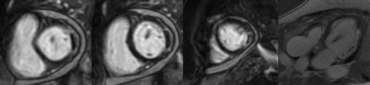 Figura 3. RMC de una paciente con infarto lateral y OMV. Figura 3. RMC de una paciente con infarto lateral y OMV.