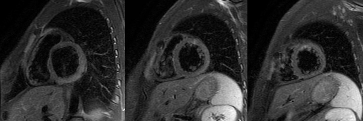 Figura 4. RMC de paciente varón de 23 años con miocarditis, que presenta importante elevación de troponinas y alteraciones de la contractilidad segmentaria en ETT. STIR: Edema en los segmentos laterales e inferiores basales-medios y apicales. Figura 4. RMC de paciente varón de 23 años con miocarditis, que presenta importante elevación de troponinas y alteraciones de la contractilidad segmentaria en ETT. STIR: Edema en los segmentos laterales e inferiores basales-medios y apicales.
