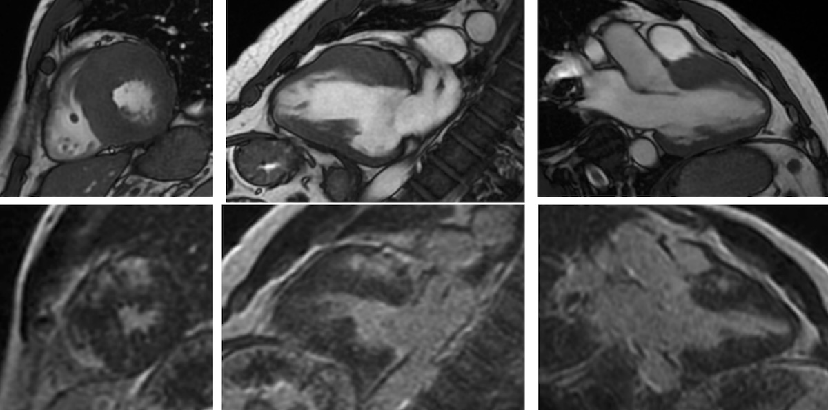 Figura 6. RMC secuencias cine steady-state freee-precession pulse (SSFP) y de supresión miocárdica en paciente varón de 44 años con MCH asimétrica con engrosamiento de los segmentos anteriores y septales y presencia de fibrosis intramiocárdica en los segmentos hipertróficos. Figura 6. RMC secuencias cine steady-state freee-precession pulse (SSFP) y de supresión miocárdica en paciente varón de 44 años con MCH asimétrica con engrosamiento de los segmentos anteriores y septales y presencia de fibrosis intramiocárdica en los segmentos hipertróficos.