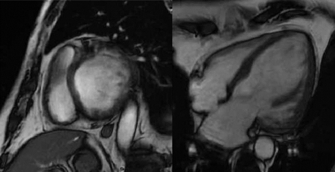 Figura 7. RMC en paciente varón de 65 años, con MSCR y miocardiopatía dilatada con disfunción VI severa. Figura 7. RMC en paciente varón de 65 años, con MSCR y miocardiopatía dilatada con disfunción VI severa.