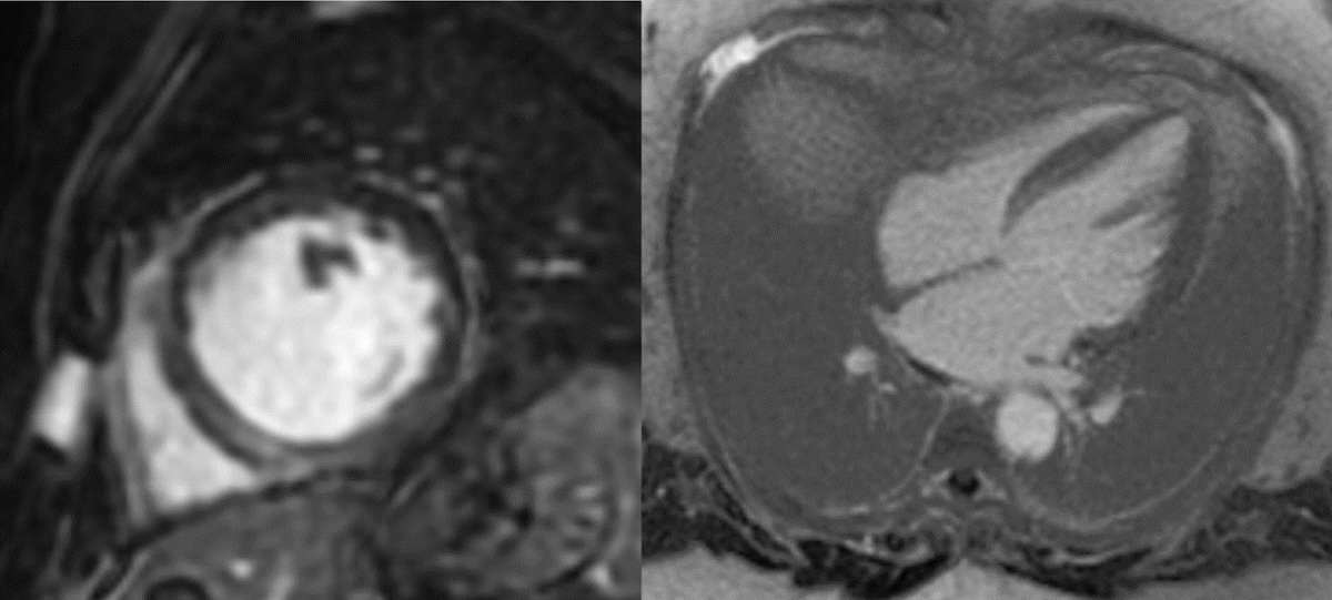 Figura 8. RMC en paciente mujer 61 años con MSCR con miocardiopatía dilatada no isquémica (MCDNI) con disfunción sistólica VI severa (FEVI 29%). RTG en relación con fibrosis mesocárdica lineal en segmentos septales. Figura 8. RMC en paciente mujer 61 años con MSCR con miocardiopatía dilatada no isquémica (MCDNI) con disfunción sistólica VI severa (FEVI 29%). RTG en relación con fibrosis mesocárdica lineal en segmentos septales.