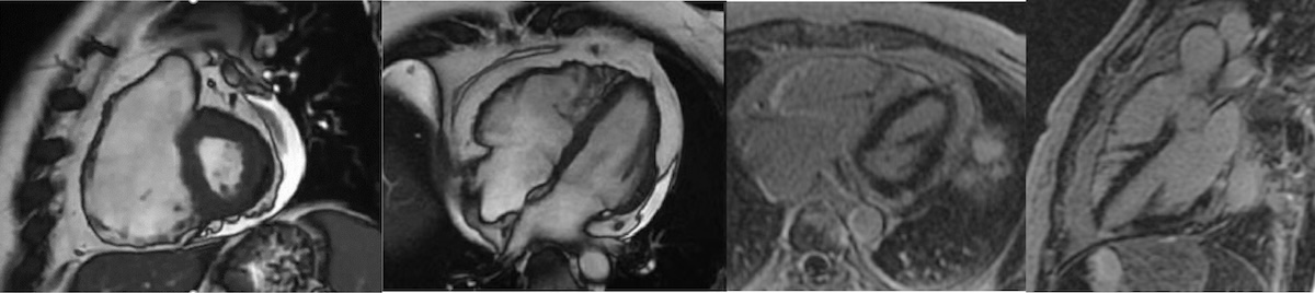 Figura 10. RMC en paciente con MCA con afectación biventricular, con VD de volúmenes aumentados y disfunción sistólica severa (FE 24%), adelgazamiento parietal y áreas aneurismáticas y discinéticas en la pared libre y en la pared diafragmática. RTG: Captación extensa del VD (la pared libre y la cara diafragmática) así como focos de realce tardío epicárdicos en los segmentos inferolateral basal y laterales apicales del VI. Figura 10. RMC en paciente con MCA con afectación biventricular, con VD de volúmenes aumentados y disfunción sistólica severa (FE 24%), adelgazamiento parietal y áreas aneurismáticas y discinéticas en la pared libre y en la pared diafragmática. RTG: Captación extensa del VD (la pared libre y la cara diafragmática) así como focos de realce tardío epicárdicos en los segmentos inferolateral basal y laterales apicales del VI.