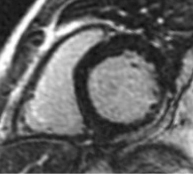 Figura 12. RTG subepicárdico en los segmentos inferolateral e inferior en paciente con MSCR. Figura 12. RTG subepicárdico en los segmentos inferolateral e inferior en paciente con MSCR.