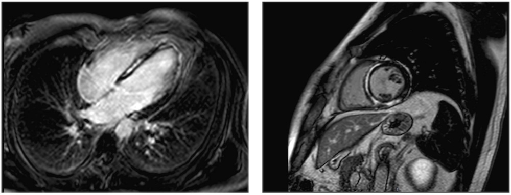 Figura 3. CRM que muestra una secuencia de realce tardío de gadolinio en un paciente con miocardiopatía arritmogénica izquierda debido a una mutación en el gen DSP. Se aprecia patrón de fibrosis extenso de subepicárdico e intramiocárdico que afecta a varios segmentos.