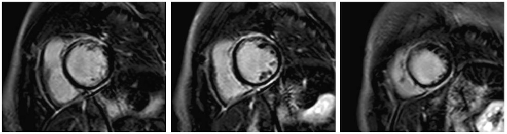Figura 4. Secuencia de realce tardío de gadolinio de una CRM, en la que se aprecia fibrosis extensa subepicárdico en anillo en una paciente con diagnóstico de miocardiopatía arritmogénica biventricular debido a una mutación tipo truncamiento en el gen DSP.