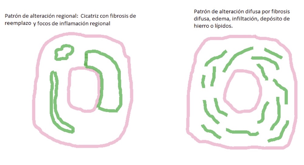 Figura 1. En la figura de arriba a la izquierda se representa un patrón regional con cicatriz subendocárdica típica de la miocardiopátia isquémica y focos de inflamación regional visible en entidades como algunas miocardiopatías no isquémicas , en las que áreas de tejido enfermo se agregan regionalmente, por ejemplo en la miocardiopatía dilatada , la miocardiopatía hipertrófica, las miocarditis o la sarcoidosis. En la figura de la derecha está representado un esquema de un patrón de alteración difusa típico de enfermedades infiltrativas como la amiloidosis o enfermedades de depósito como la hemocromatosis o la enfermedad de Fabry.