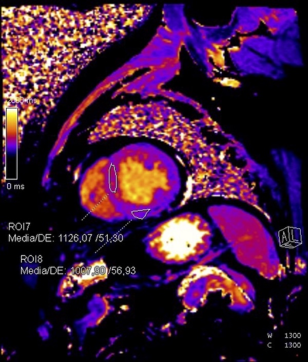 Figura 2. Mapa T1 nativo. El ROI 7 está situado en la zona de infarto septal medio ventricular mostrando un valor elevado de 1126,07 ms. El ROI 8 , está situado en una región no infartada con un valor dentro de la normalidad de 1007,9 ms.