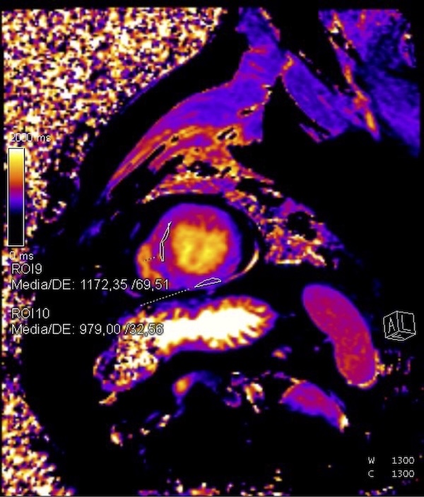 Figura 3. Mapa T1 nativo sin contraste. ROI 9 localizado en región de infarto septal en región más apical con valor elevado de 1172,35ms. El ROI 10 se sitúa en tejido miocárdico no infartado con un valor de 979 ms.