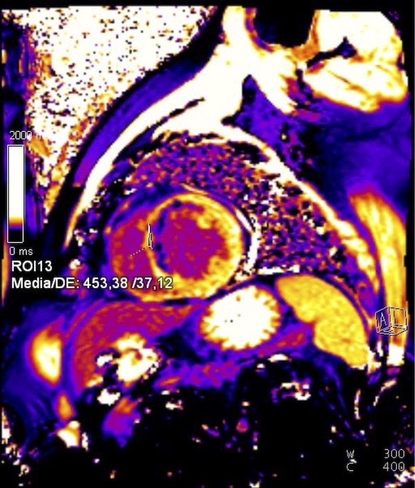 Figura 4. Mapa T1 post constraste. Se aprecia banda de hiporrealce subendocárdica en zona infartada de región anteroseptal.