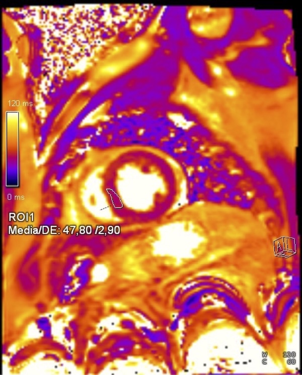 Figura 5. ROI 1 localizado en tejido no infartado adyacente al infarto con valor ROI 1: 47,8.