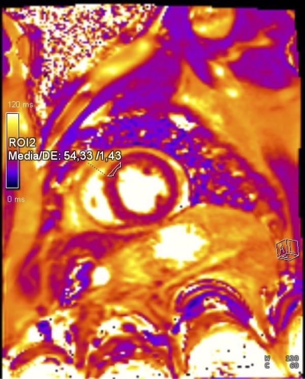 Figura 6. ROI 2: 54,33 En zona del infarto se identifica elevación del valor de mapa T2 respecto a tejido sano. Figura 6. ROI 2: 54,33 En zona del infarto se identifica elevación del valor de mapa T2 respecto a tejido sano.