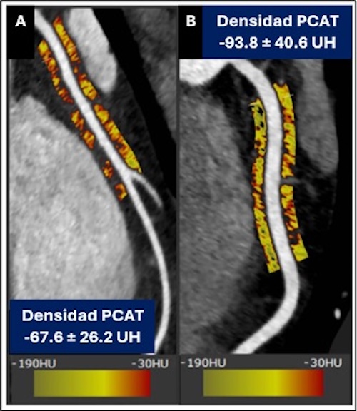 Figura 5. Casos representativos de PCAT en un paciente con alta y baja densidad de PCAT.        A:  Reconstrucción multiplanar curva de la CD en un paciente con disección coronaria espontánea, mostrando alta densidad de PCAT.  B: Reconstrucción multiplanar curva de la CD en un paciente con hipertensión e historia de tabaquismo mostrando baja densidad de PCAT.  PCAT: atenuación del tejido adiposo pericoronario. CD: arteria coronaria derecha