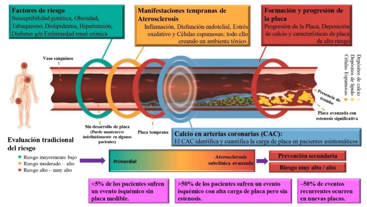 Anexo 5. Gráfico conceptual del continuo de riesgo cardiovascular, que incorpora la aterosclerosis subclínica avanzada.  Advanced subclinical atherosclerosis: A novel category within the cardiovascular risk continuum with distinct treatment implications. Am J Prev Cardiol. 2022 Dec 24;13:100456