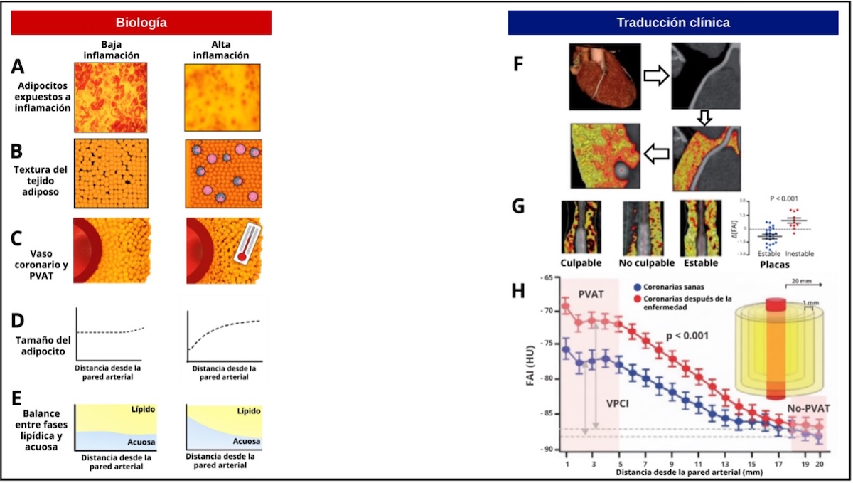 Anexo 7.  Representación esquemática de la biología subyacente a la detección de la inflamación coronaria mediante imágenes PVAT Imaging Vascular Inflammation.  JACC Basic Transl Sci. 2023 Dec 13;9(5):710-732.