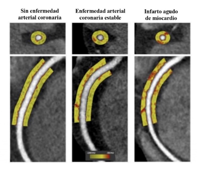 Anexo 8. Diferentes mapas de atenuación de PVAT mediante Angiotomografía Coronaria, en las diferentes etapas de EAC.   Eur Heart J Cardiovasc Imaging. 2021.