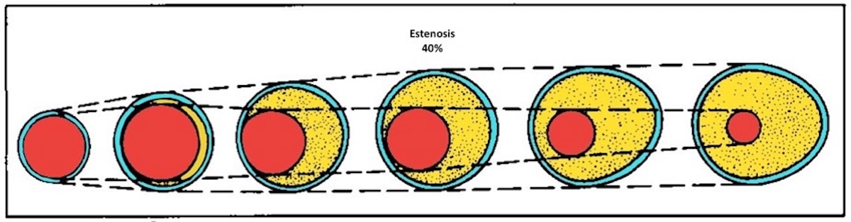 Figura 2. Es necesario el incremento de volumen de la placa de modo excéntrico para que se reduzca entonces la luz vascular.  Modificado de Glagov, S. (12)