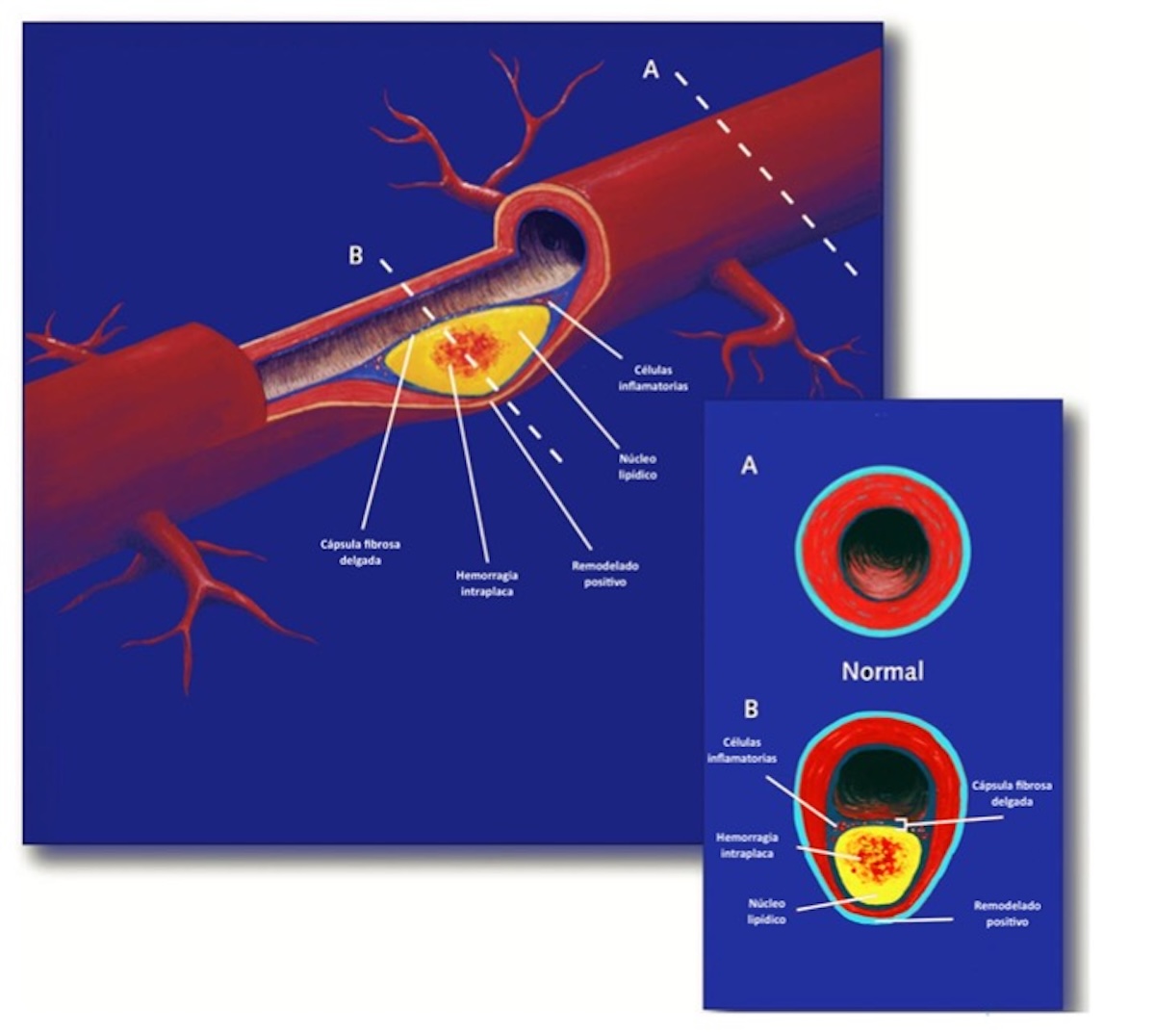 Figura 3. Podemos tener placas voluminosas de características vulnerables con escasa reducción de la luz. Modificado de Alsheikh-Aali A, et al. (13).
