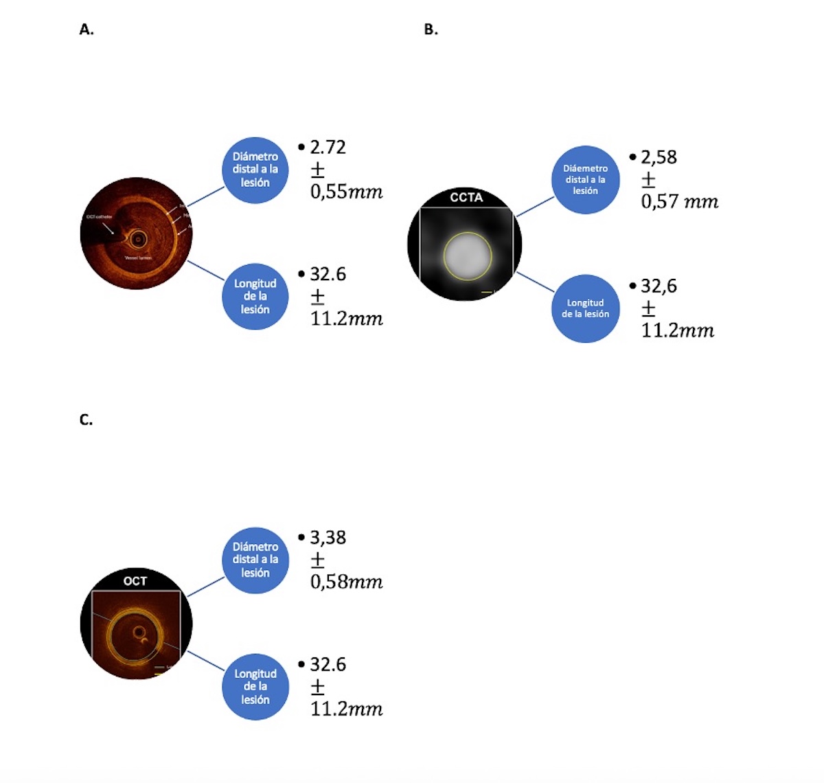 Figura 3. Promedios de longitudes y diámetros del vaso distal a la lesión en cada uno de los métodos de imagen utilizados. En A) diámetro medio del lumen con OCT, B) diámetro medio del lumen con CCTA, C) diámetro medio lámina elástica externa por OCT.