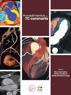 Procedimientos en TC coronaria